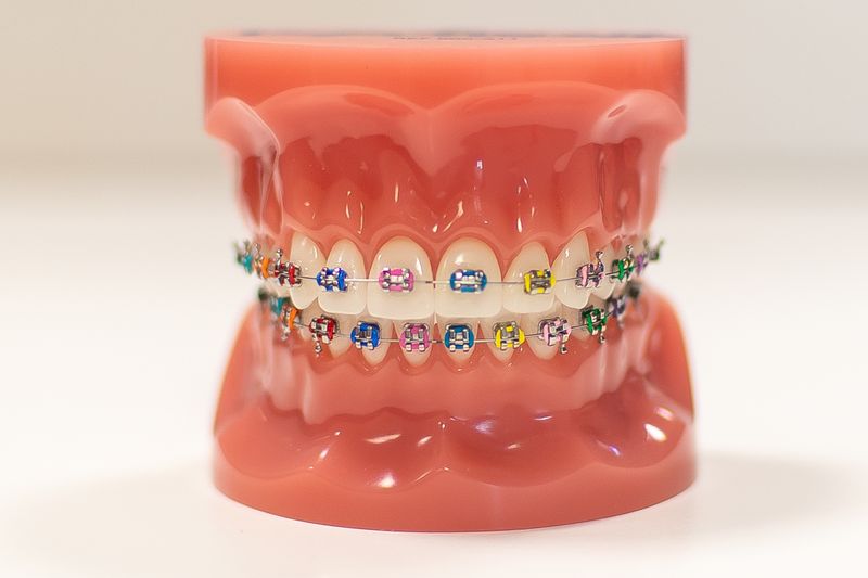 Kids Braces Cost
